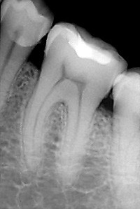 Фото здорового зуба на рентгеновском снимке